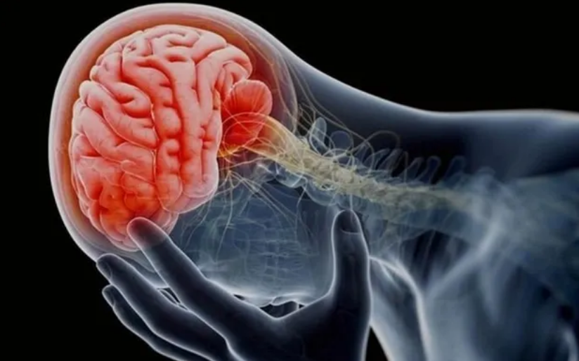 Tu cuerpo te puede avisar un mes antes si sufrirás un derrame cerebral ...